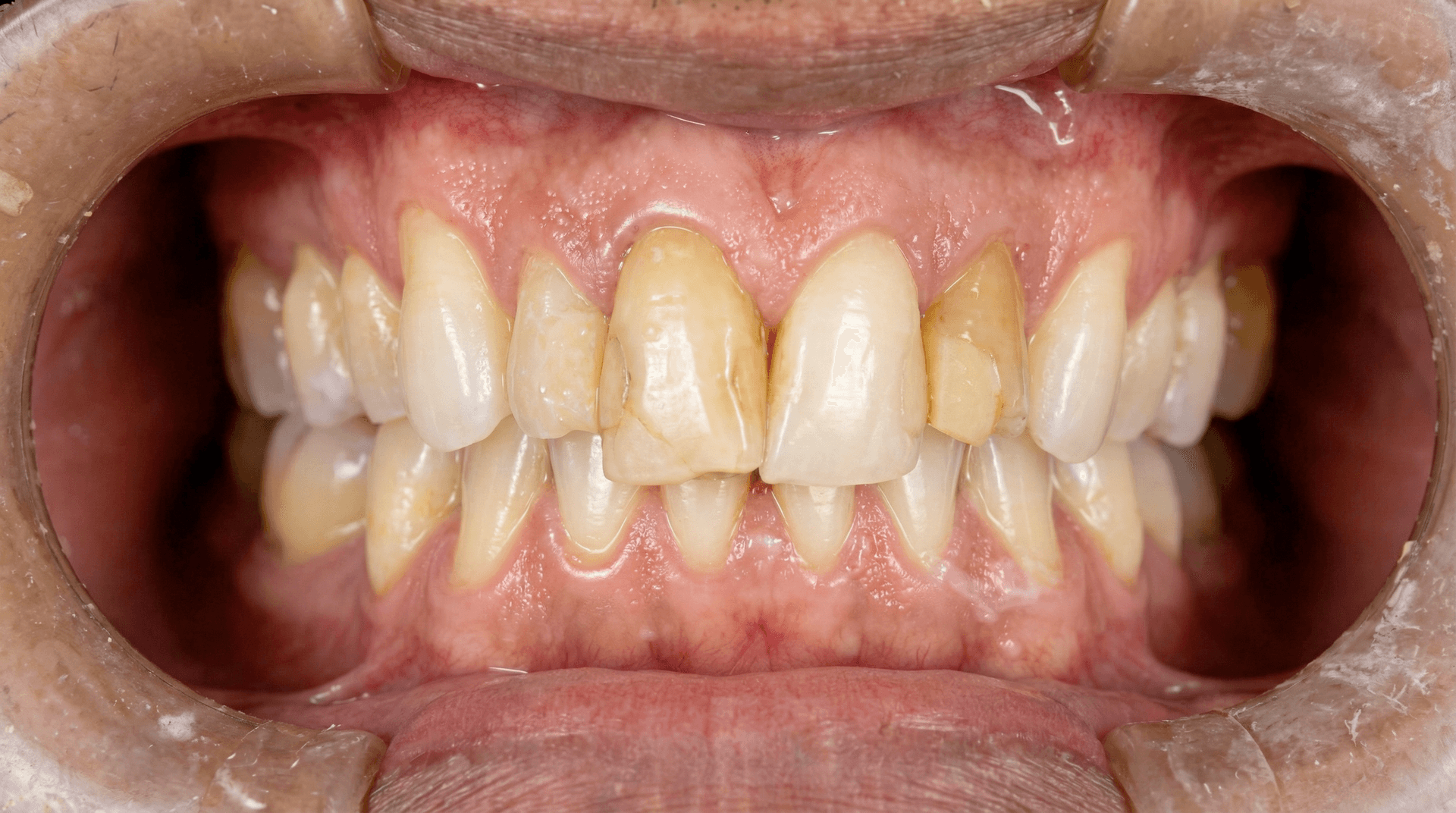 intraoral depois